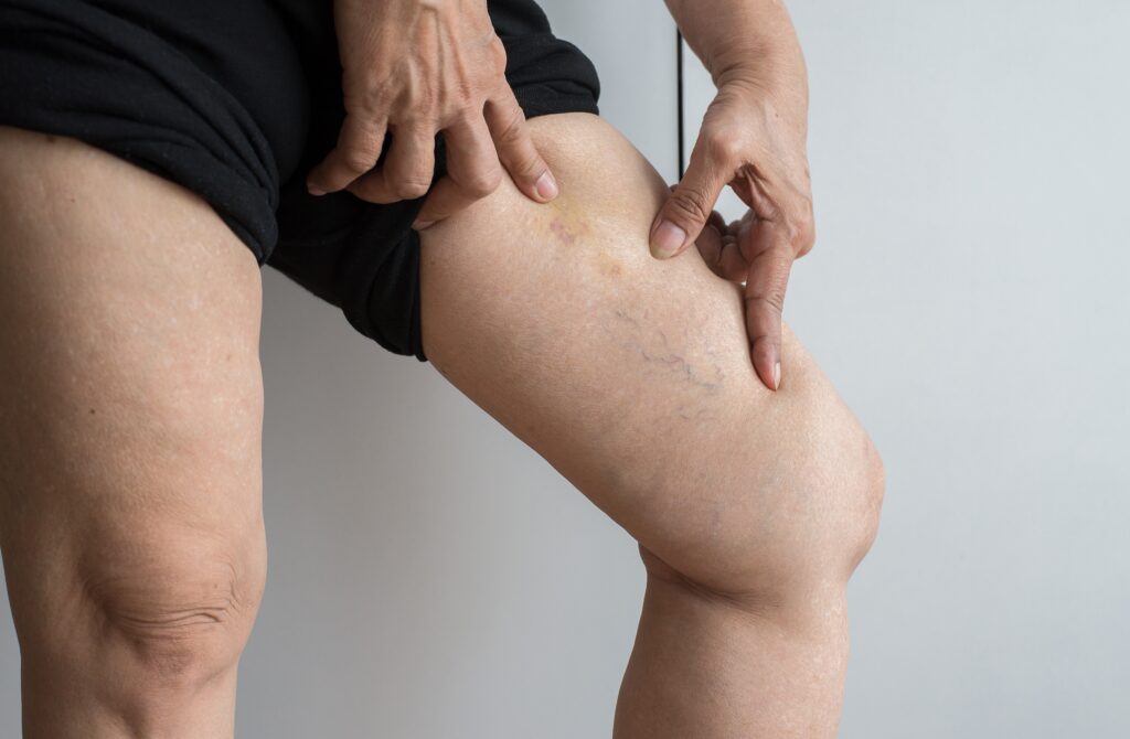 What Causes Spider and Varicose Veins?