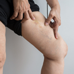 varicose veins