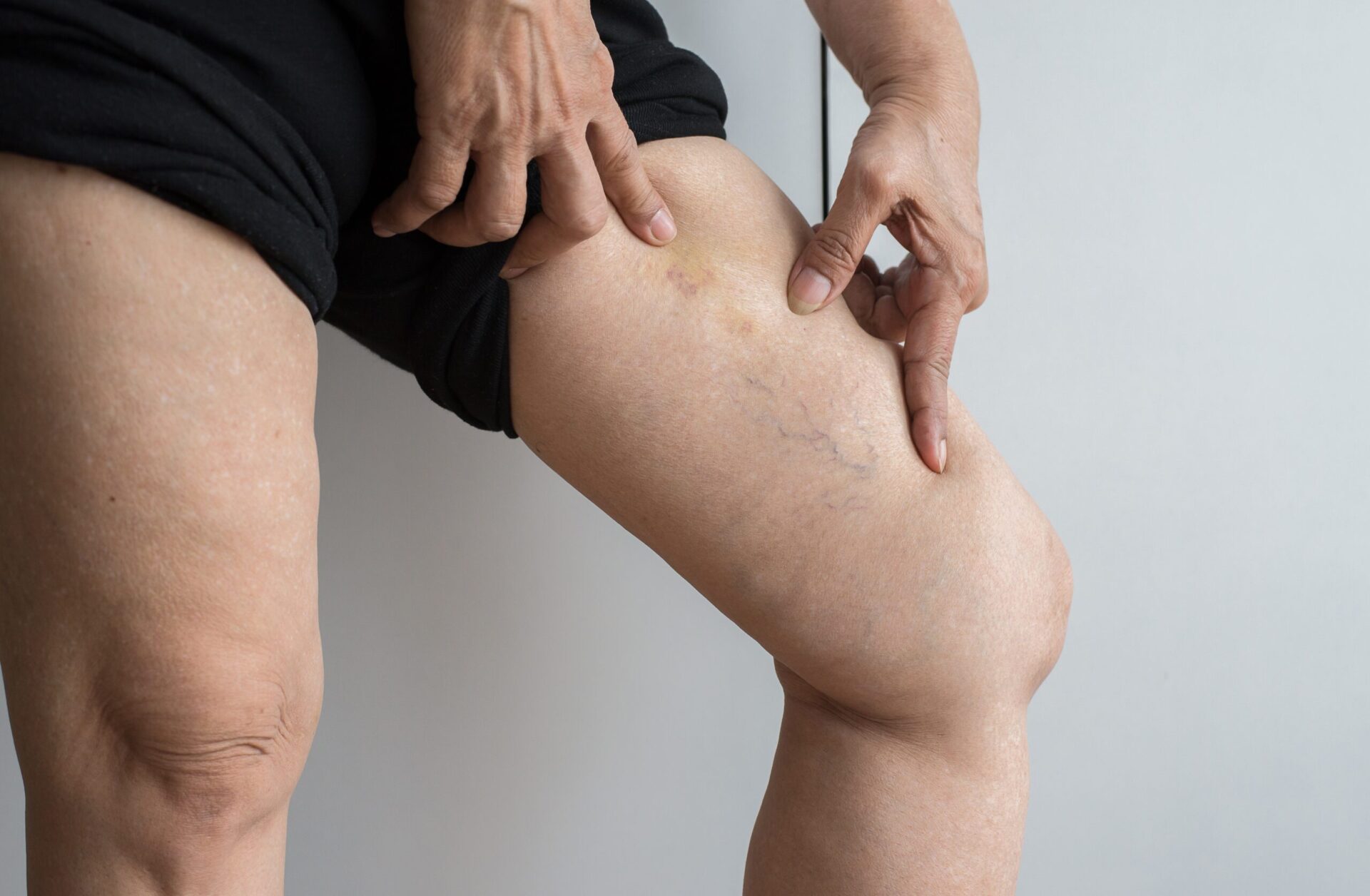 varicose veins